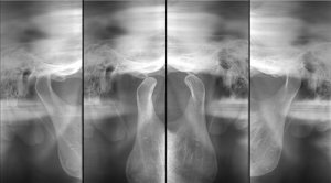 Radiografia da Articulação Têmporo-Mandibular (ATM) 